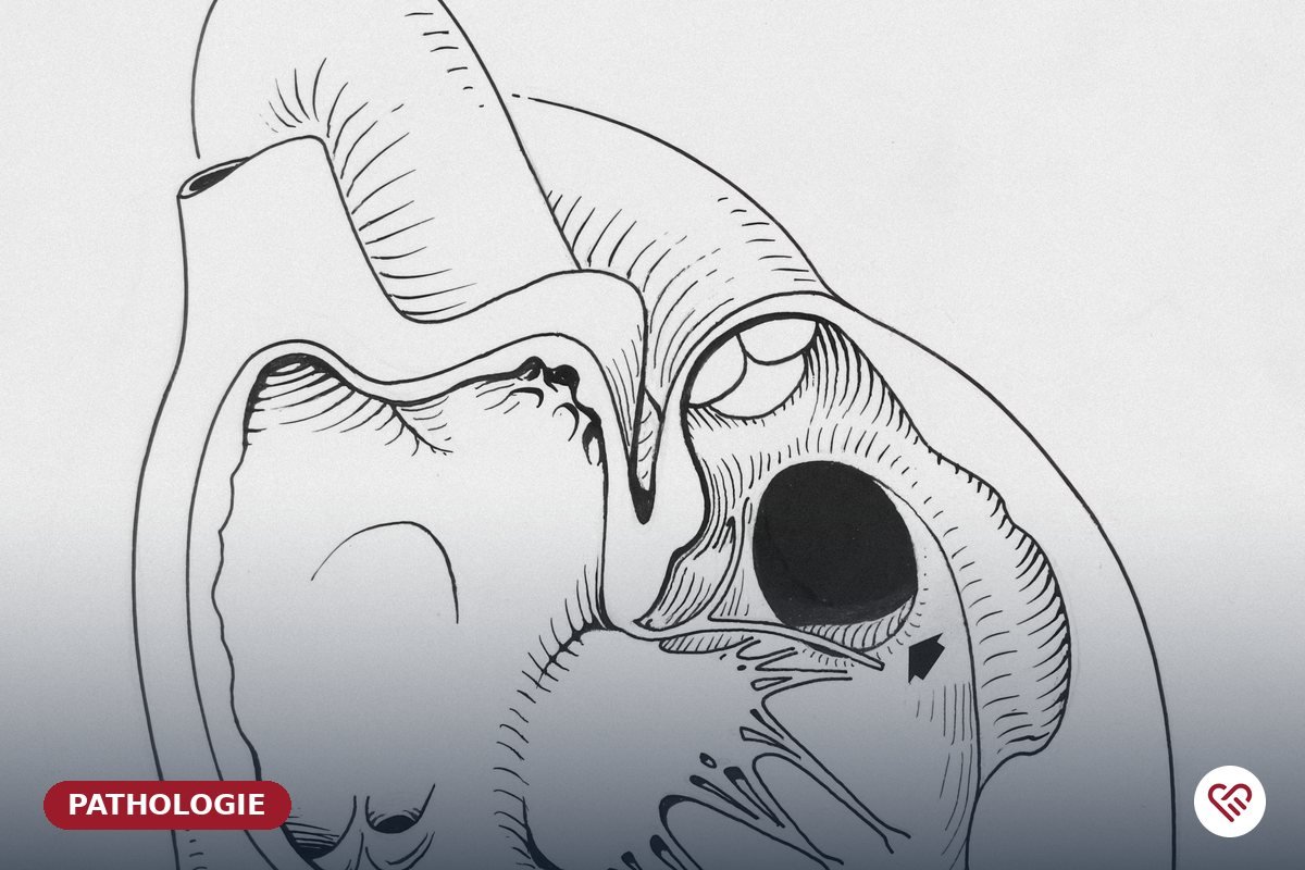 L'insuffisance cardiaque — Dr Agueznai, cardiologue à Casablanca