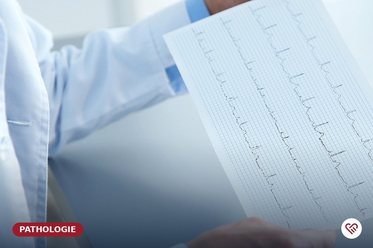 La fibrillation auriculaire — Dr Agueznai, cardiologue à Casablanca