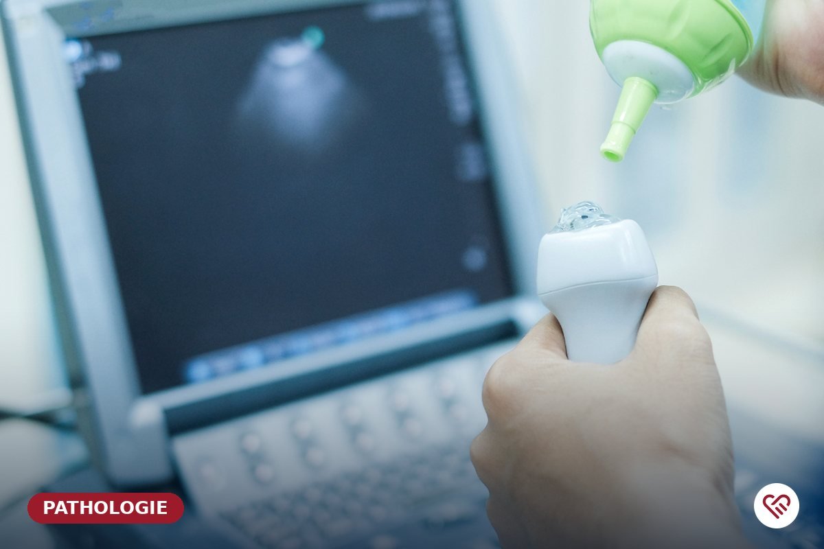 La thrombose veineuse profonde et l'embolie pulmonaire — Dr Agueznai, cardiologue à Casablanca