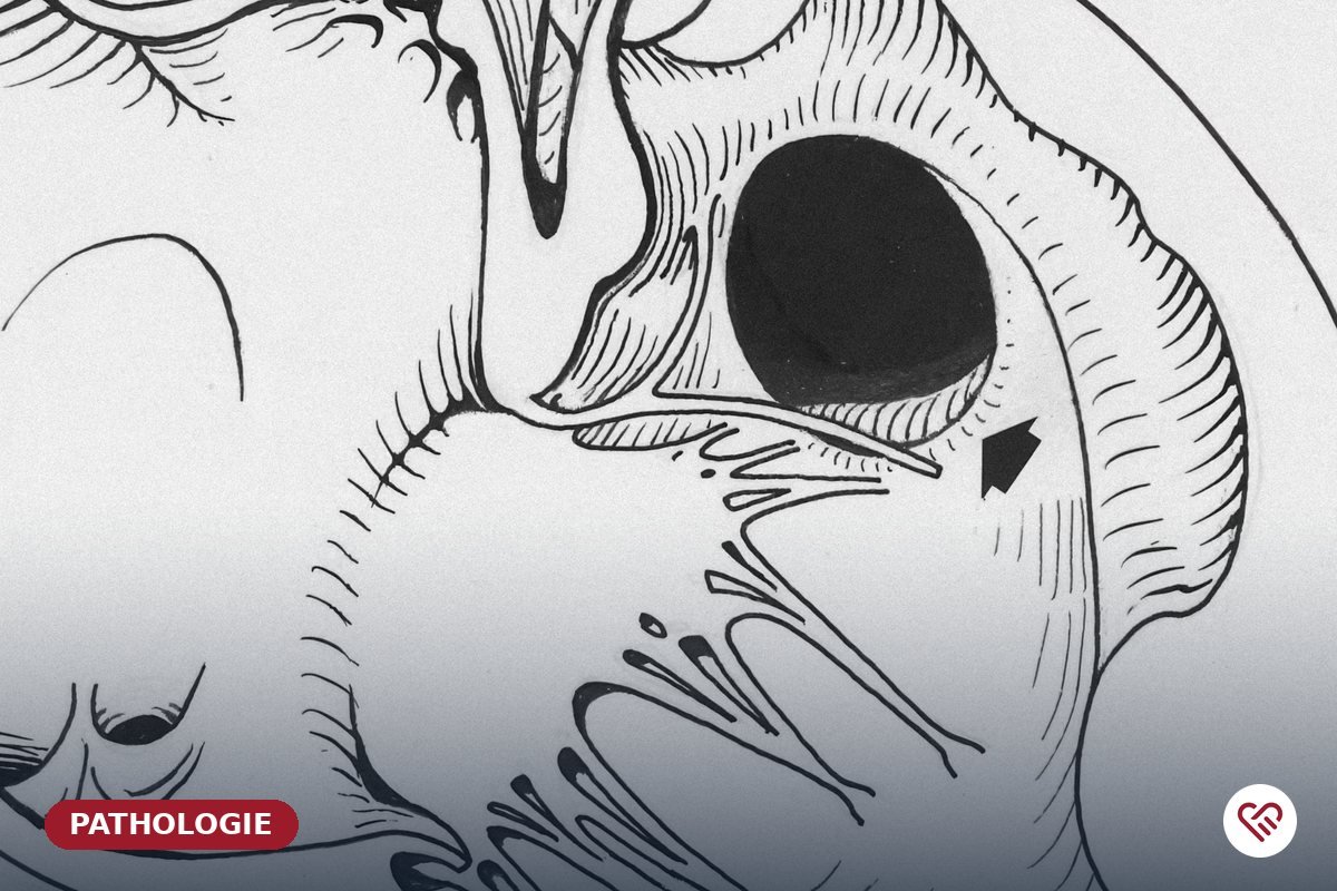 Les valvulopathies — Dr Agueznai, cardiologue à Casablanca
